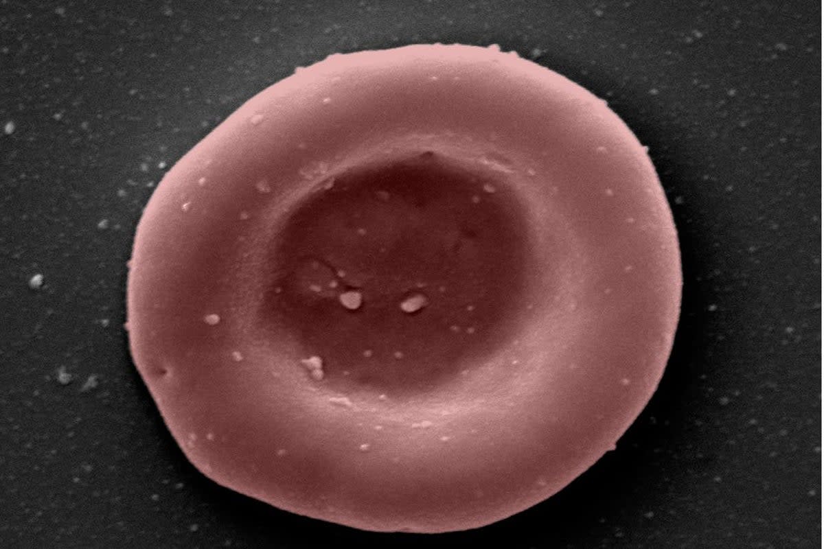 ‘Lab-grown red blood cells transfused in to person in a world first’ (NHSBT/PA)