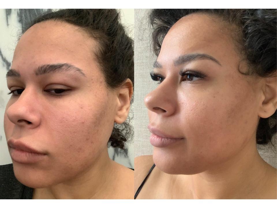 Before (left) and after (right) – our tested noticed a major reduction in breakouts and redness (Amerley Ollennu)