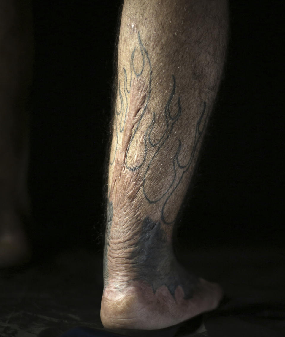 In this Wednesday. Oct. 24, 2018, photo, Iraqi soldier Saad Khudeir displays a tattoo on his leg to cover scars of the burns he suffered in a car bombing, in Baghdad, Iraq. “I don’t want just to cover my wounds, but also to tell the story behind my physical and emotional ones,” he said. “Through Christian icons, I want to say that there is no difference between Muslim and Christians, and the flames explain the fire still raging inside me for my loss,” he added. (AP Photo/Hadi Mizban)