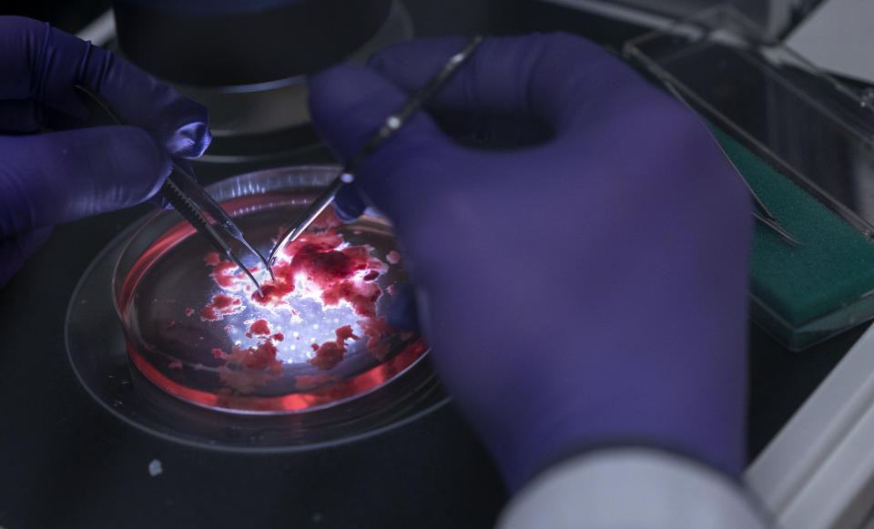 PHILADELPHIA, PA - AUGUST 15: Fadi Jacob, a visiting graduate student from Johns Hopkins University, dissects a a glioblastoma brain tumor at the University of Pennsylvania Clinical Research Building in Philadelphia, Pennsylvania on August 15, 2018.  The tumor, which came straight from post-op will be dissected into hundreds of small pieces that will be used to grow tumor organdies. (Photo by Jessica Kourkounis for The Washington Post via Getty Images)