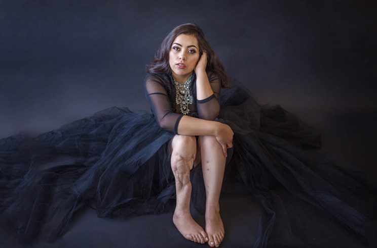 Claudina Vega, whose leg was nearly severed in a car accident when she was 5, is showing off her legs for the first time. (Photo: Ginny Haupert/Carers News)