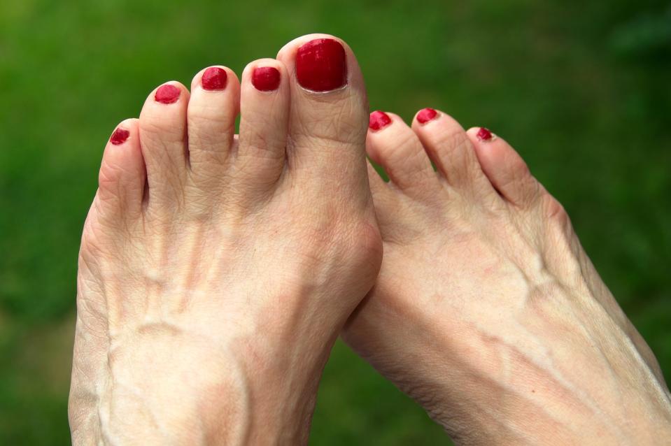 Pain is a major factor in leading many to choose bunion surgery.