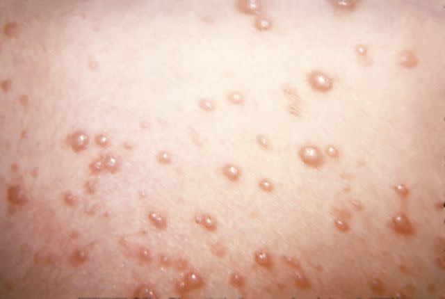 Smith Collection/Gado / Getty Images Chickenpox blisters