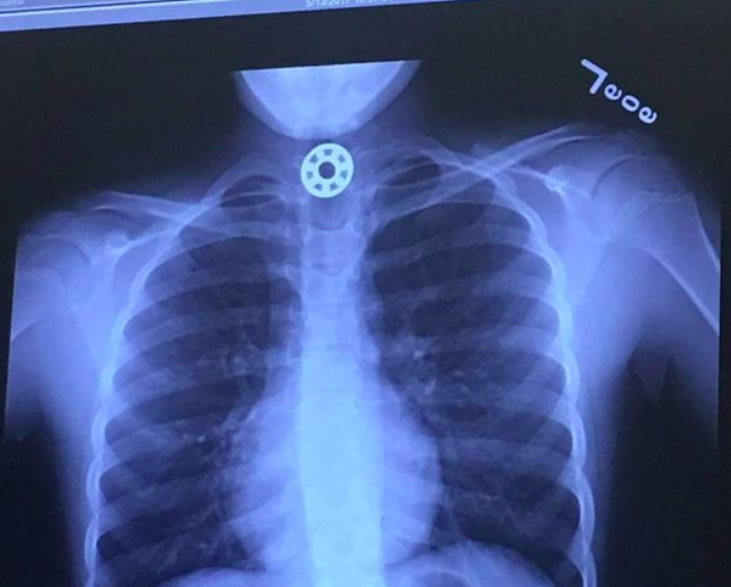 An X-ray showed the spinner lodged in Britton's esophagus (Facebook/Kelly Rose Joniec)