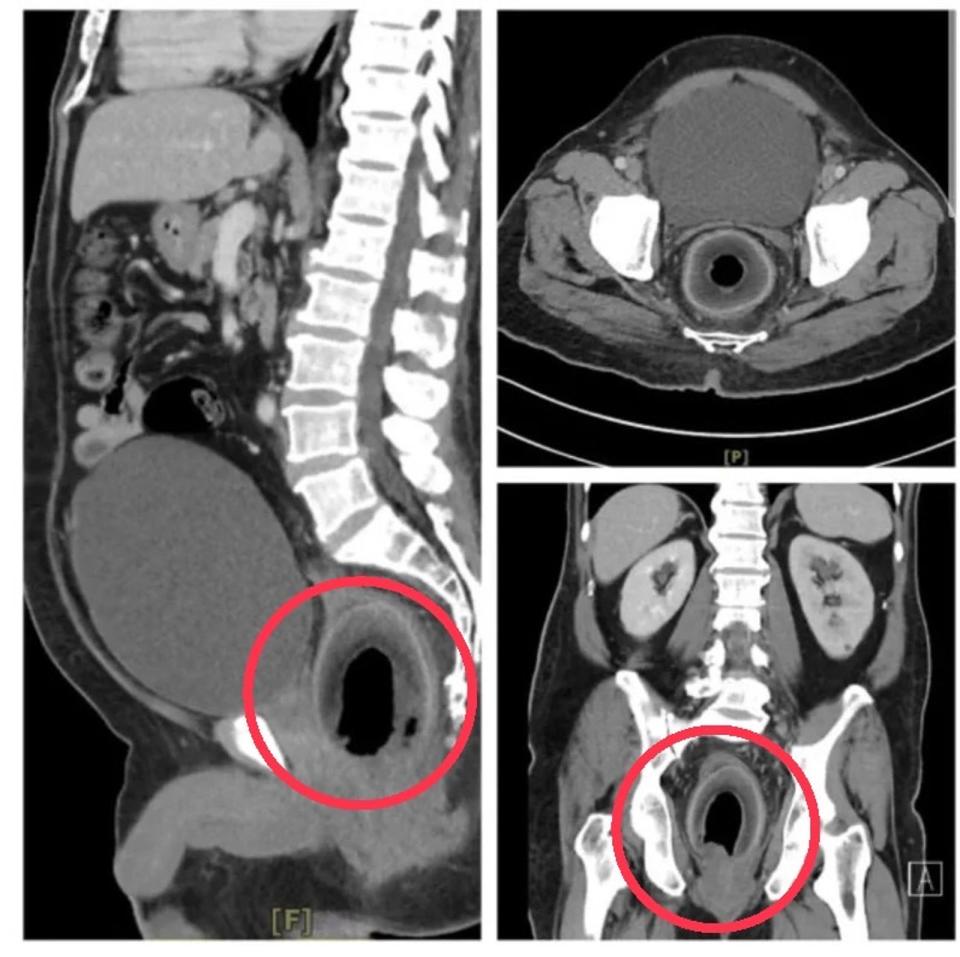 該男子經腹部電腦斷層，發現椰子（紅圈處）壓迫尿道，導致無法排尿，裡面大概有近2,000 C.C的尿。（翻攝自英國醫學期刊BJS）