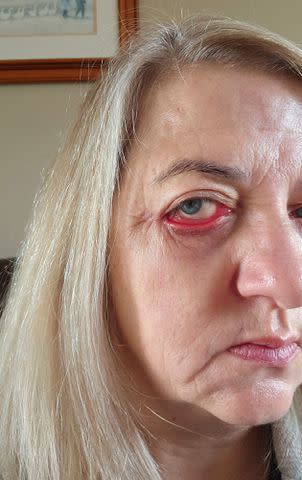 <p>Kennedy News and Media</p> A woman from Ireland who traveled to Turkey for an inexpensive eye lift said it left her looking like a "Basset hound."