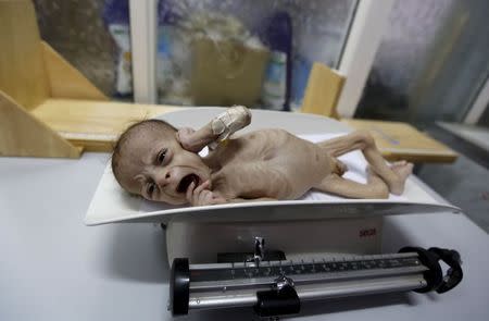 Ali Mohammed al-Tawaari, a six-month-old malnourished boy, cries as he is weighed in a malnutrition intensive care unit in Sanaa, Yemen July 30, 2015. REUTERS/Khaled Abdullah