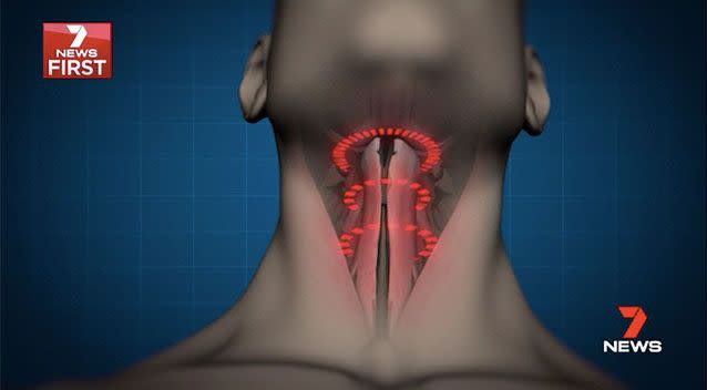 Nearly 800,000 Australians suffer from sleep apnea, where the airway closes repeatedly during sleep. Picture: 7 News