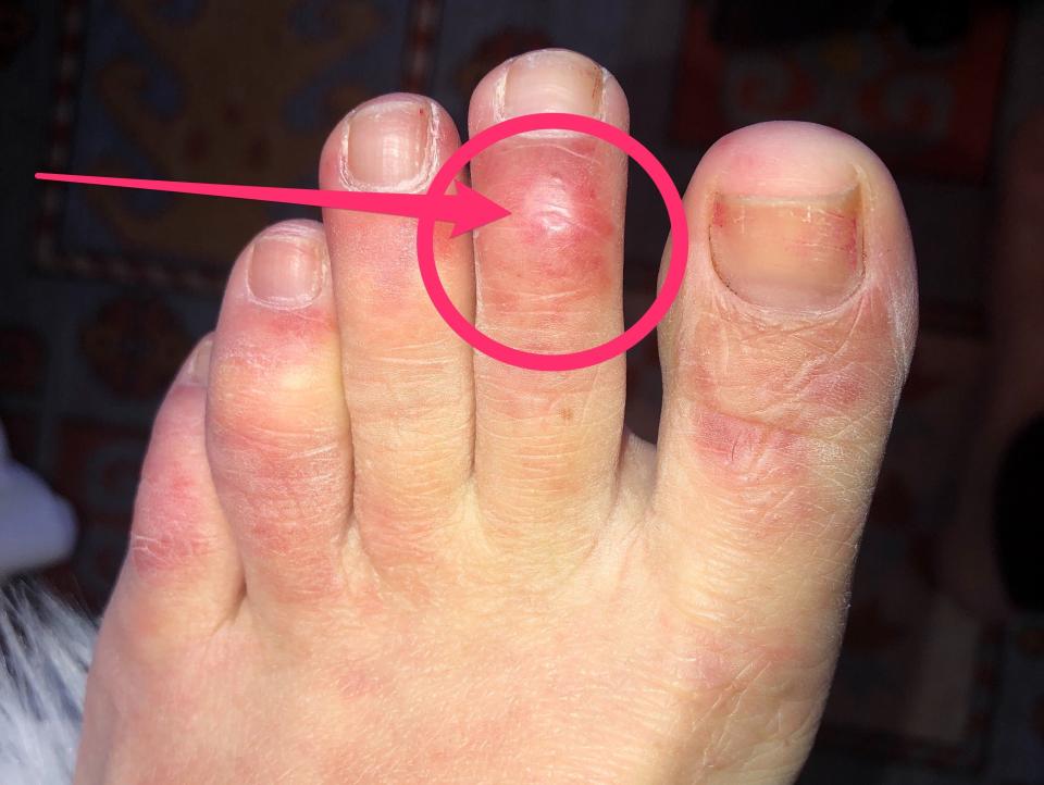 An example of "COVID Toes"