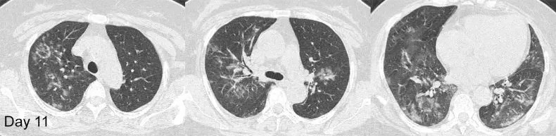 Pulmones de una paciente de 54 años en el día 11 de presentar los síntomas y recibir tratamiento con ativirales (RSNA)