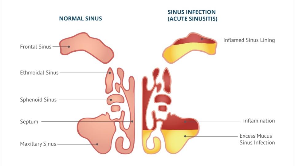 An illustration of sinusitis, or swollen and inflamed nasal cavities
