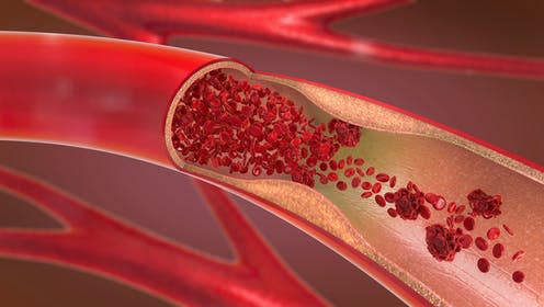 <span class="caption">Beta amyloid causes damage to the blood vessels.</span> <span class="attribution"><a class="link " href="https://www.shutterstock.com/image-illustration/3d-illustration-constricted-narrowed-artery-blood-1254693310" rel="nofollow noopener" target="_blank" data-ylk="slk:Christoph Burgstedt/ Shutterstock;elm:context_link;itc:0;sec:content-canvas">Christoph Burgstedt/ Shutterstock</a></span>