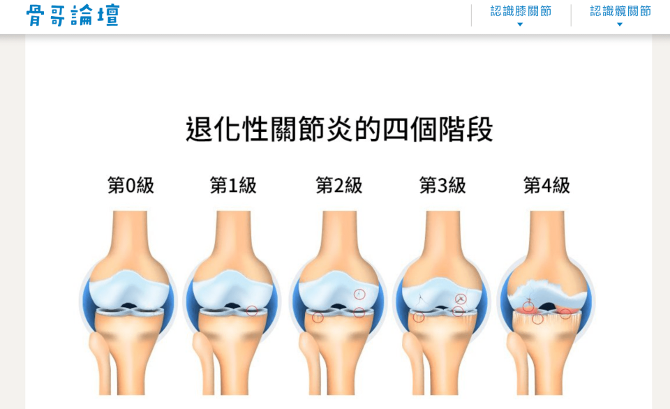 ▲退化性關節炎的4個階段 圖：翻攝自「骨哥論壇」