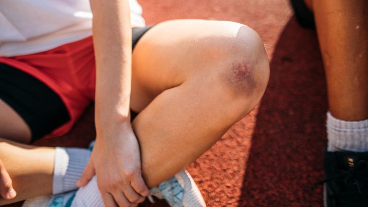  Close up of a child's bruised knee as they sit cross-legged on a running track next to another child in athletic clothes. 