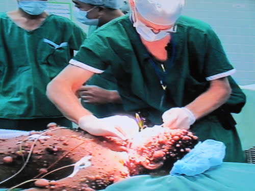 Patient Thach Thi Sa Ly during the operation. (Photo courtesy of TNO)