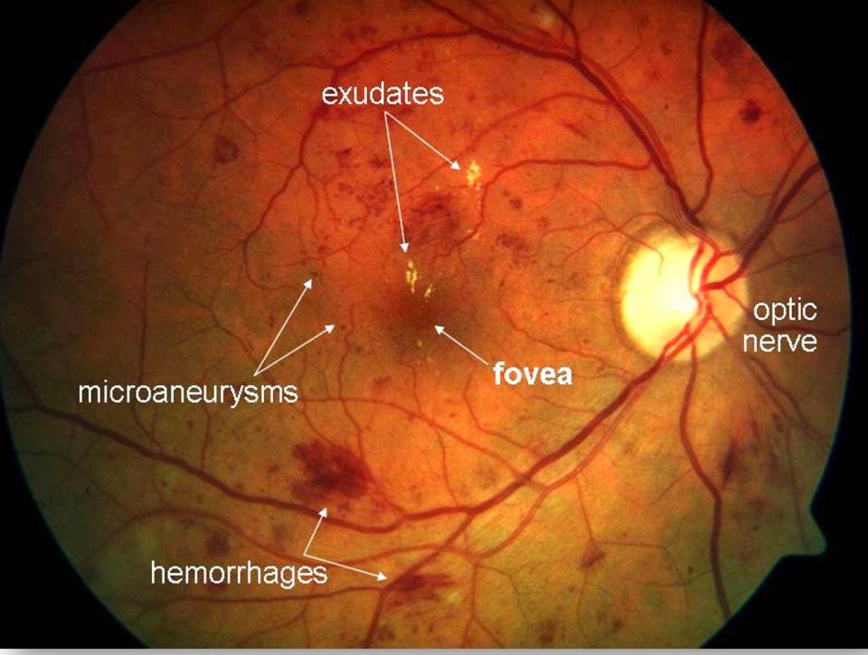 Fundus camera image of the human eye showing early signs of leaky blood vessels that can lead to blindness. The signs include hemorrhages, microaneurysms and exudates, lipid residues that have seeped from leaky blood vessels.