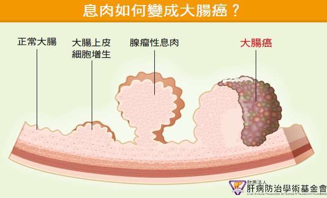 息肉如何變成大腸癌？