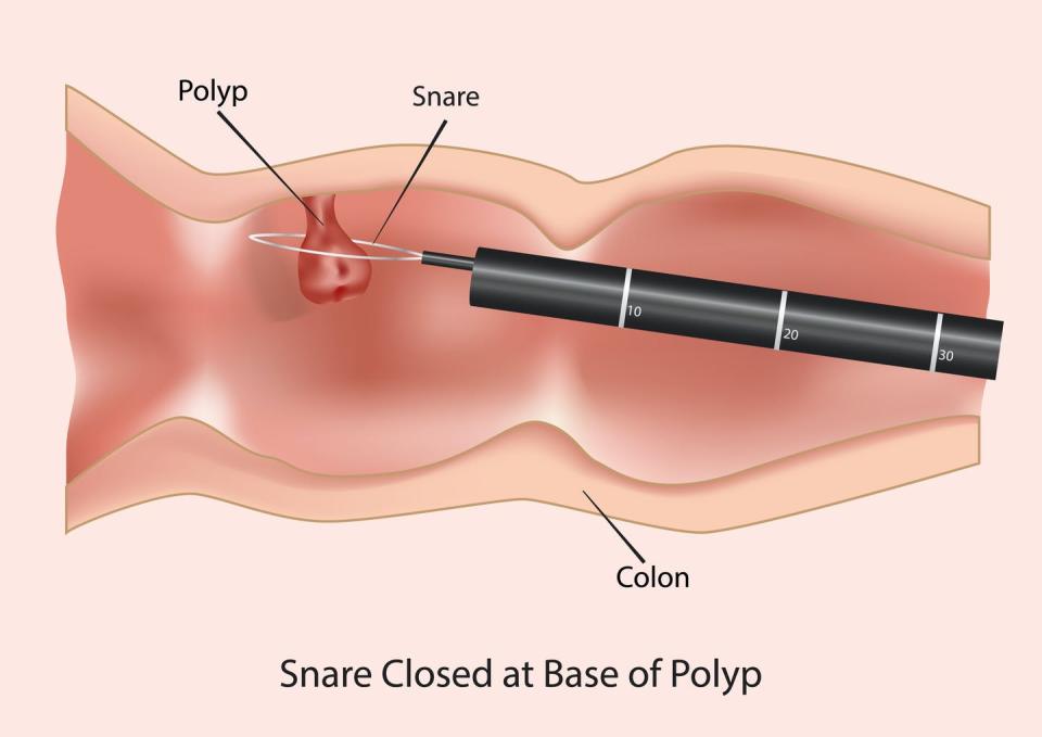 <span class="caption">Precancerous growths called polyps can be easily removed during a colonoscopy.</span> <span class="attribution"><a class="link " href="https://www.shutterstock.com/image-vector/polypectomy-using-colonoscopy-789408859" rel="nofollow noopener" target="_blank" data-ylk="slk:Sezer33/Shutterstock.com;elm:context_link;itc:0;sec:content-canvas">Sezer33/Shutterstock.com</a></span>