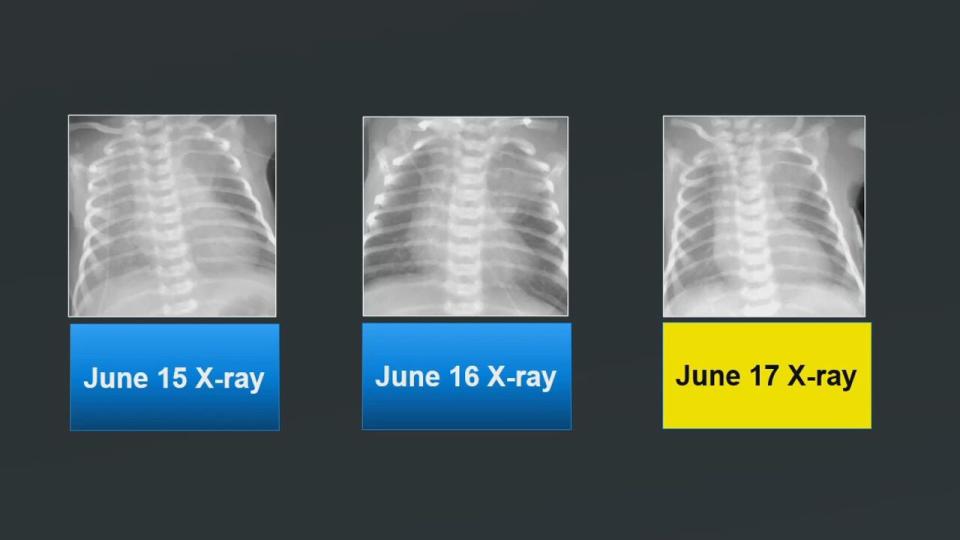 Tristian Blanton's three X-Rays.