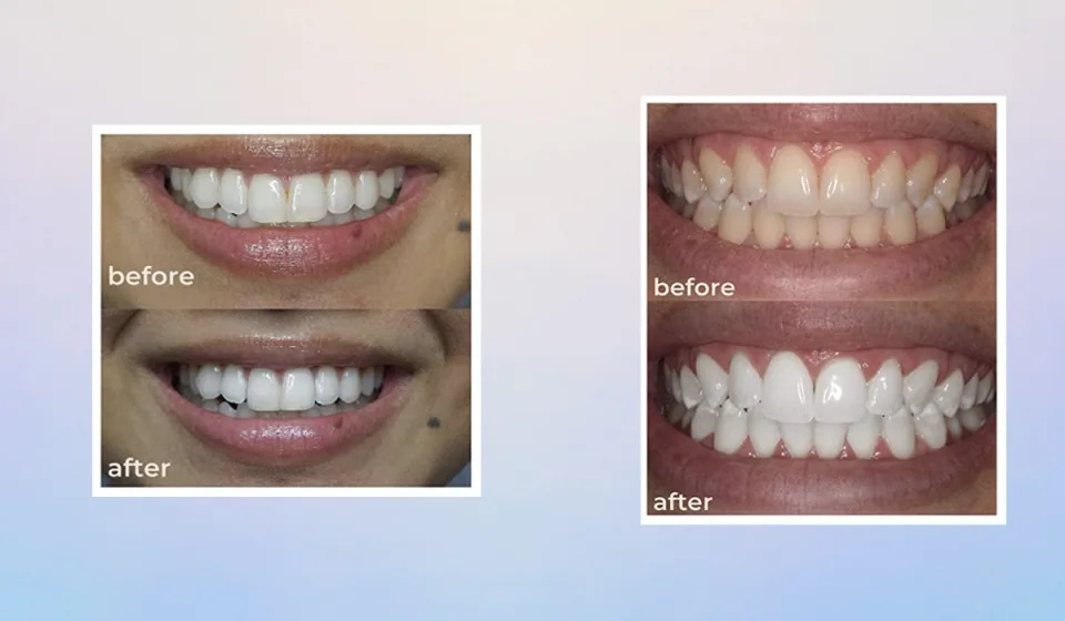 Side-by-side comparison of teeth whitening