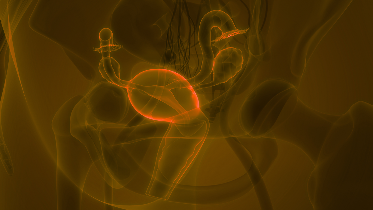 Ovarian cysts represented by brown toned X-ray of a woman's pelvis.