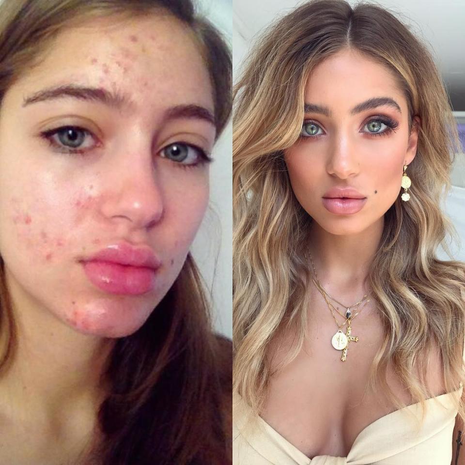 <p>Les hashtags #SkinPositivity et #acneisnormal deviennent de plus en plus viraux et plus de 600 messages ont d’ores et déjà été publiés. Crédit photo : Instagram belle_lucia </p>