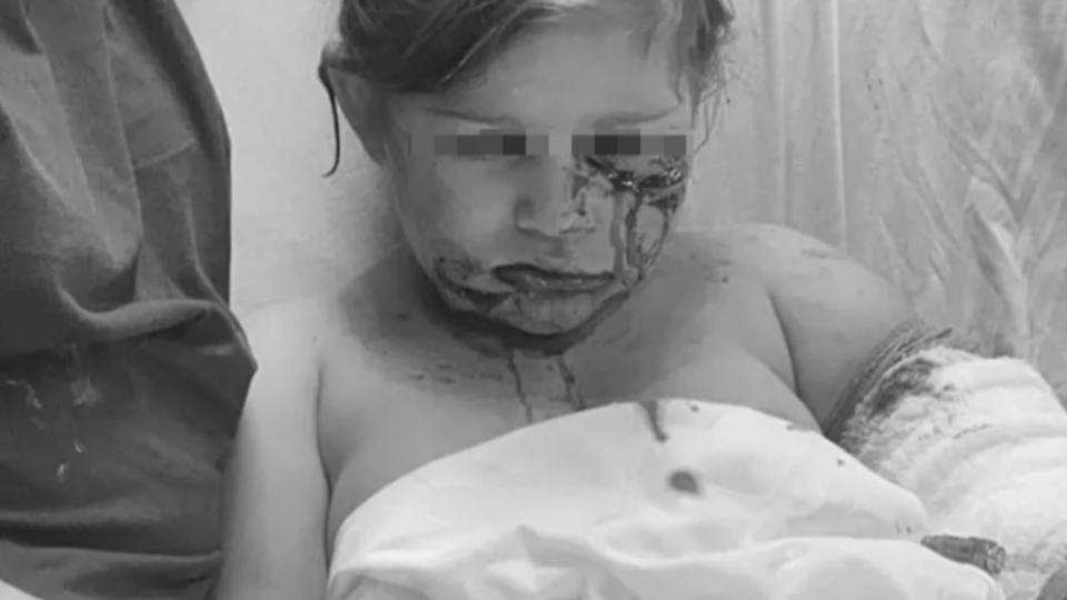 女童送醫時滿臉是血。（圖／翻攝自Gofundme）