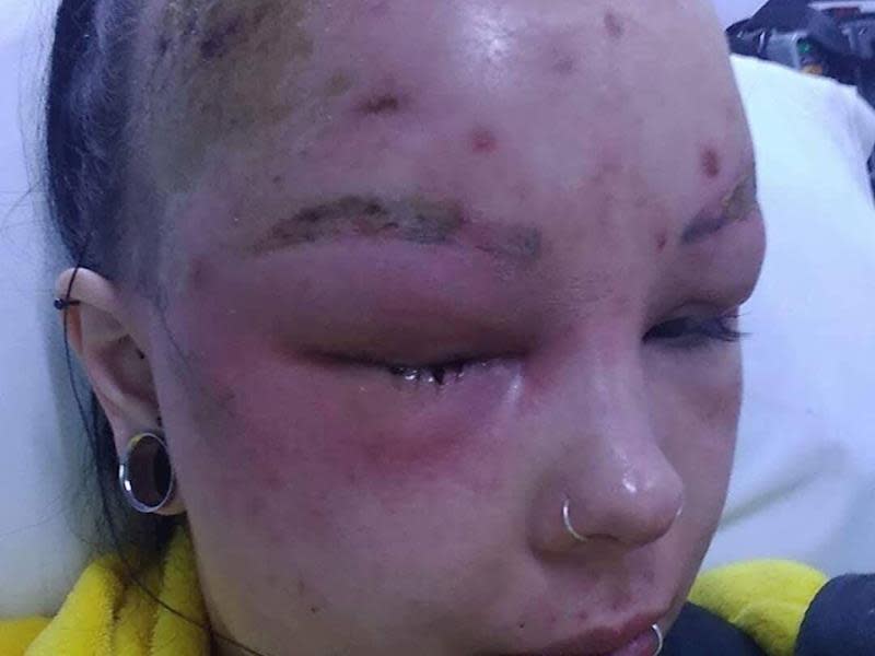 On Sunday her face became so swollen she was unable to see out of one eye. Source: GiveALittle