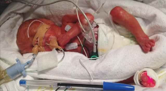 Baby Jacob Horne was born prematurely at just 24 weeks. Photo: Supplied