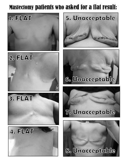 Not Putting on a Shirt - If you're facing mastectomy & considering going  flat, you should know that there are many ways to produce an aesthetic flat  closure (as defined by the