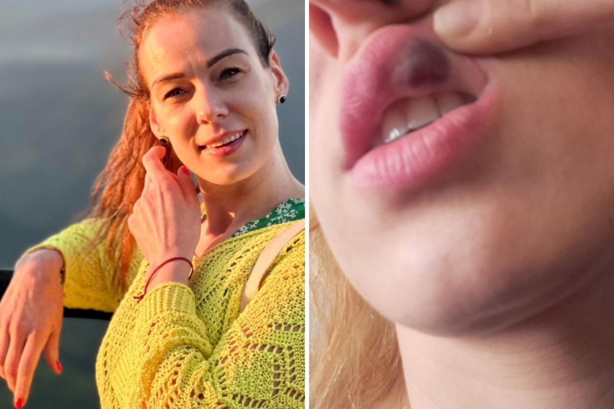 Lip fillers saved my life by helping to detect my leukaemia