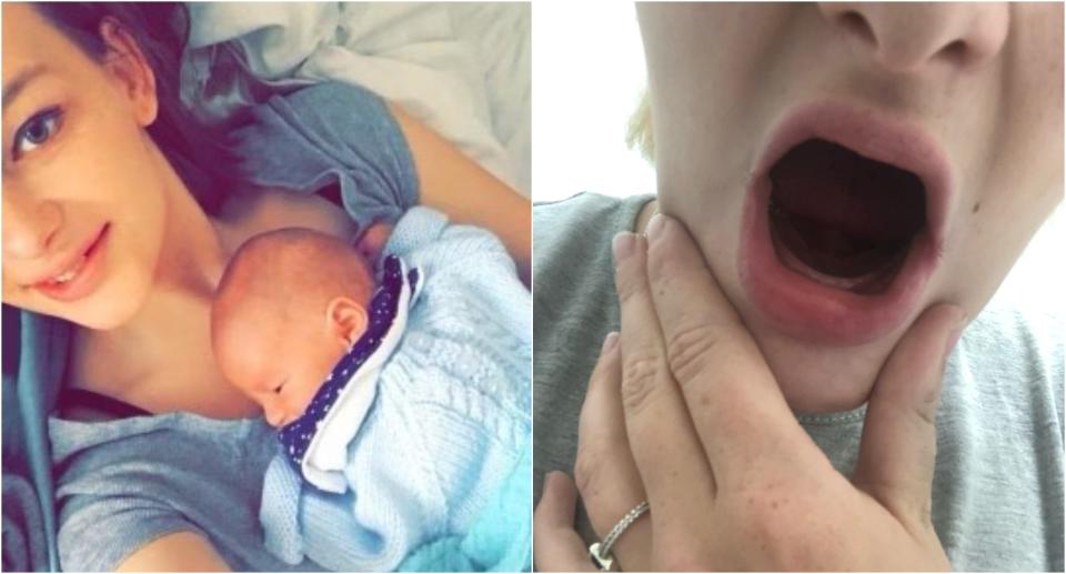 Louise Cooper's teeth were so damaged from hyperemesis gravidarum she had to have them removed. (SWNS)