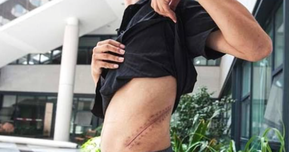 Cicatriz de Wang tras vender un riñón en el mercado negro. (Foto: Ifeng.com)