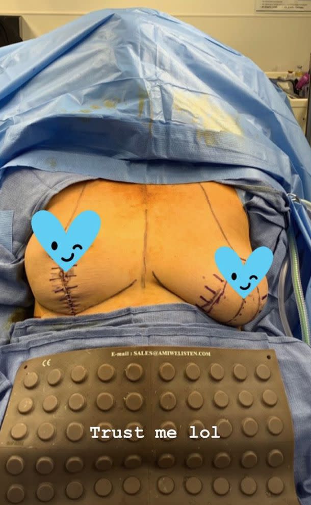 Chrissy Teigen shared a throwback photo pre-surgery of when she had her breast implants removed in June. The 34-year-old model shared the surgery pic after many people didn't believe she had the surgery.