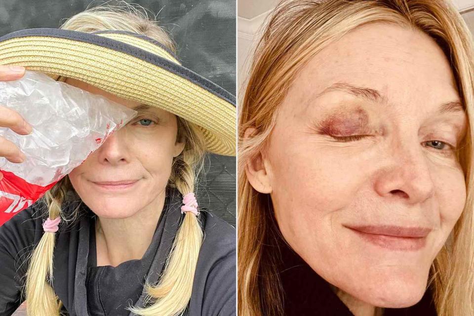 Michelle Pfeiffer Shows Off Black Eye After Pickleball Mishap