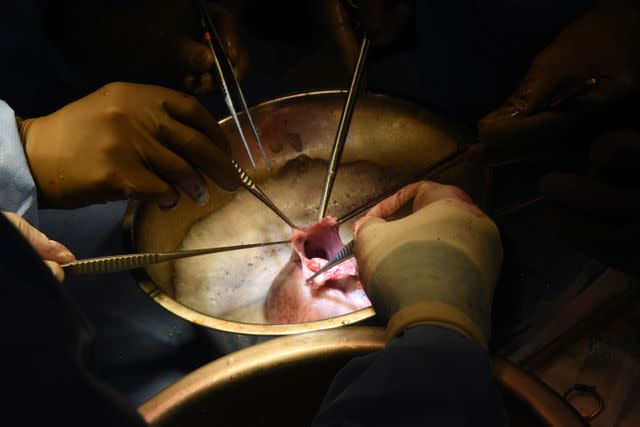 <p>Deborah Kotz/University of Maryland School of Medicine via AP</p> Surgeons perform a pig heart transplant into Lawrence Faucette