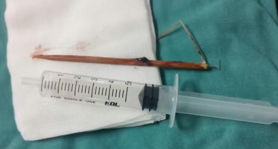 The bamboo skewer which became lodged in the boy's brain. Source: Weibo