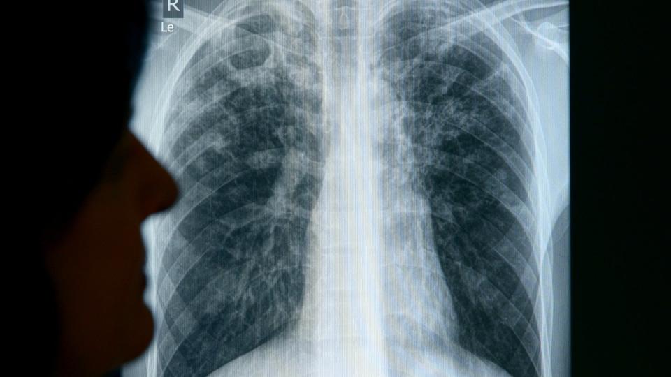 Röntgenaufnahme eines an Tuberkulose erkrankten Patienten. Foto: Rainer Jensen