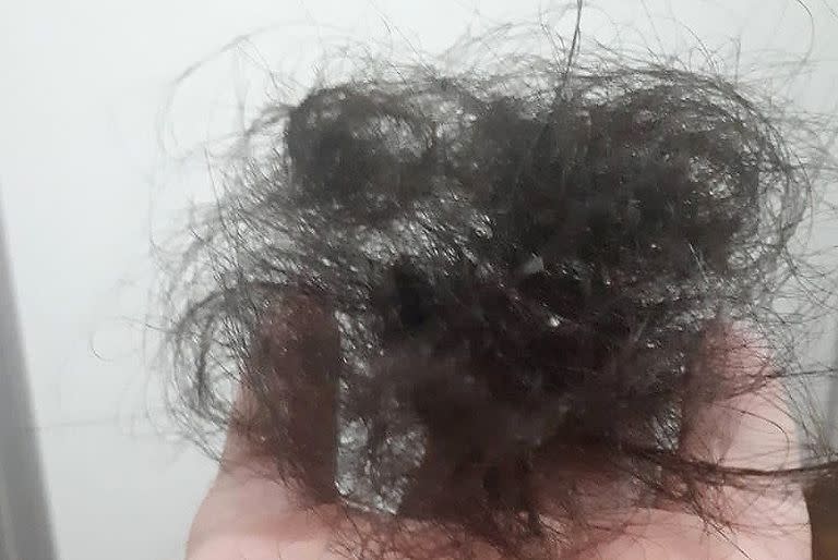 Caída del pelo y covid-19