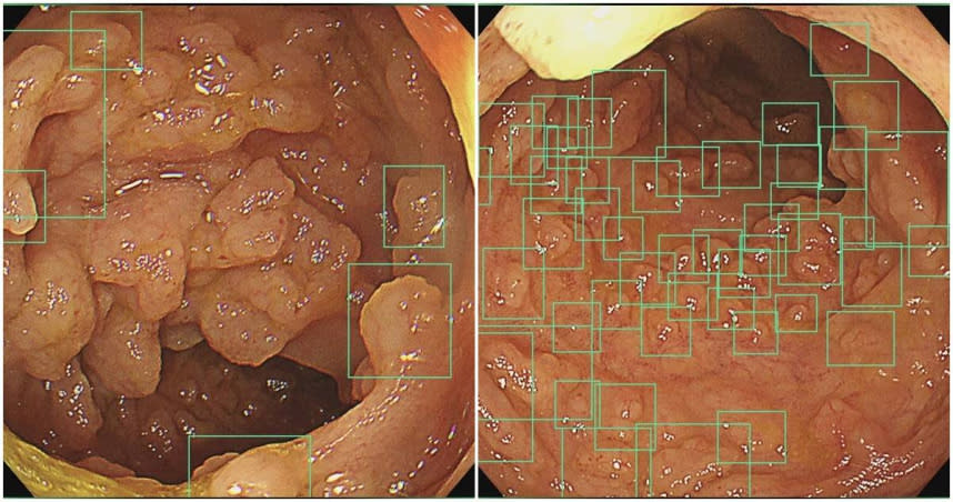 AI大腸鏡照息肉。（圖／翻攝胰臟醫師林相宏禾馨民權內科診所臉書）