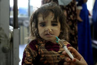 A malnourished girl treated at the Indira Gandhi hospital in Kabul, Afghanistan, Wednesday, May 18, 2022. Some 1.1 million Afghan children under the age of five will face malnutrition by the end of the year. , as hospitals wards are already packed with sick children . (AP Photo/Ebrahim Noroozi)