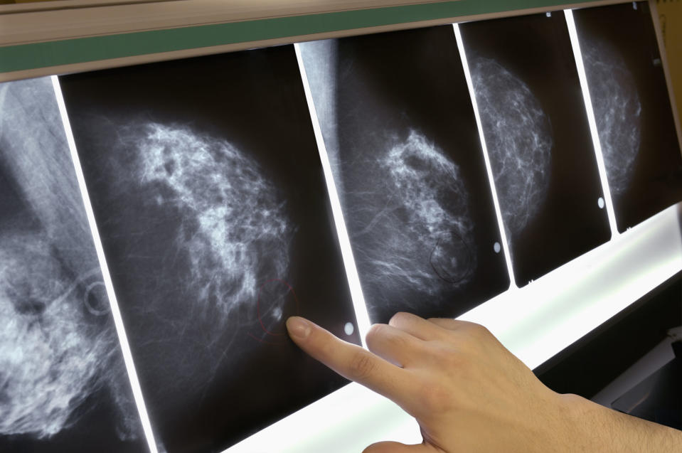 MIT researchers have invented a new AI-driven way of looking at mammogramsthat can help detect breast cancer in women up to five years in advance