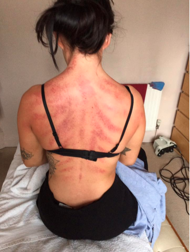 This is the impact a hairdresser's job has on her back. Photo: Facebook