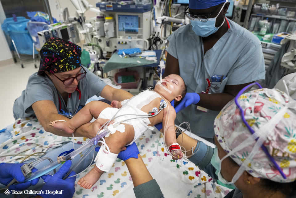 It took a team of 17 staff to separate baby Ella and Eliza, twins born conjoined by the abdomen. (Courtesy Texas Children's Hospital )