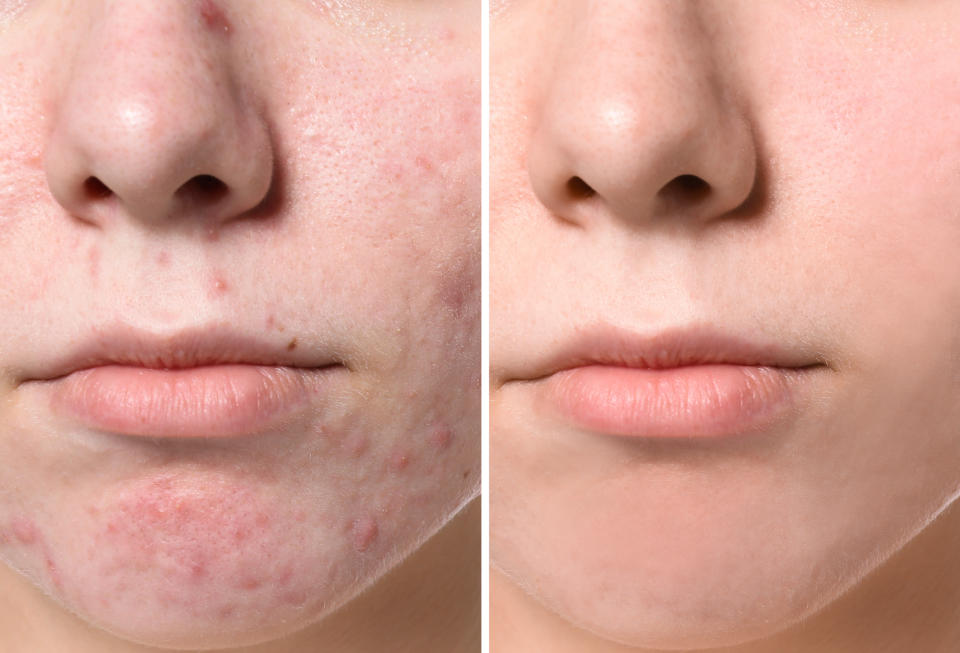 Before-After-Acne-Clear-Skin