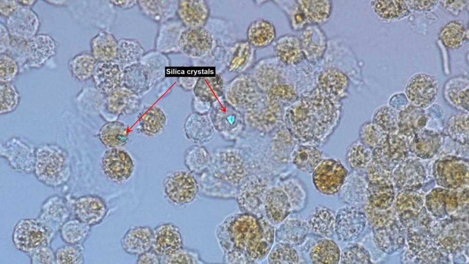 Cells taken from the lungs of a patient with silicosis, notice the speck of silica dust shining brightly.