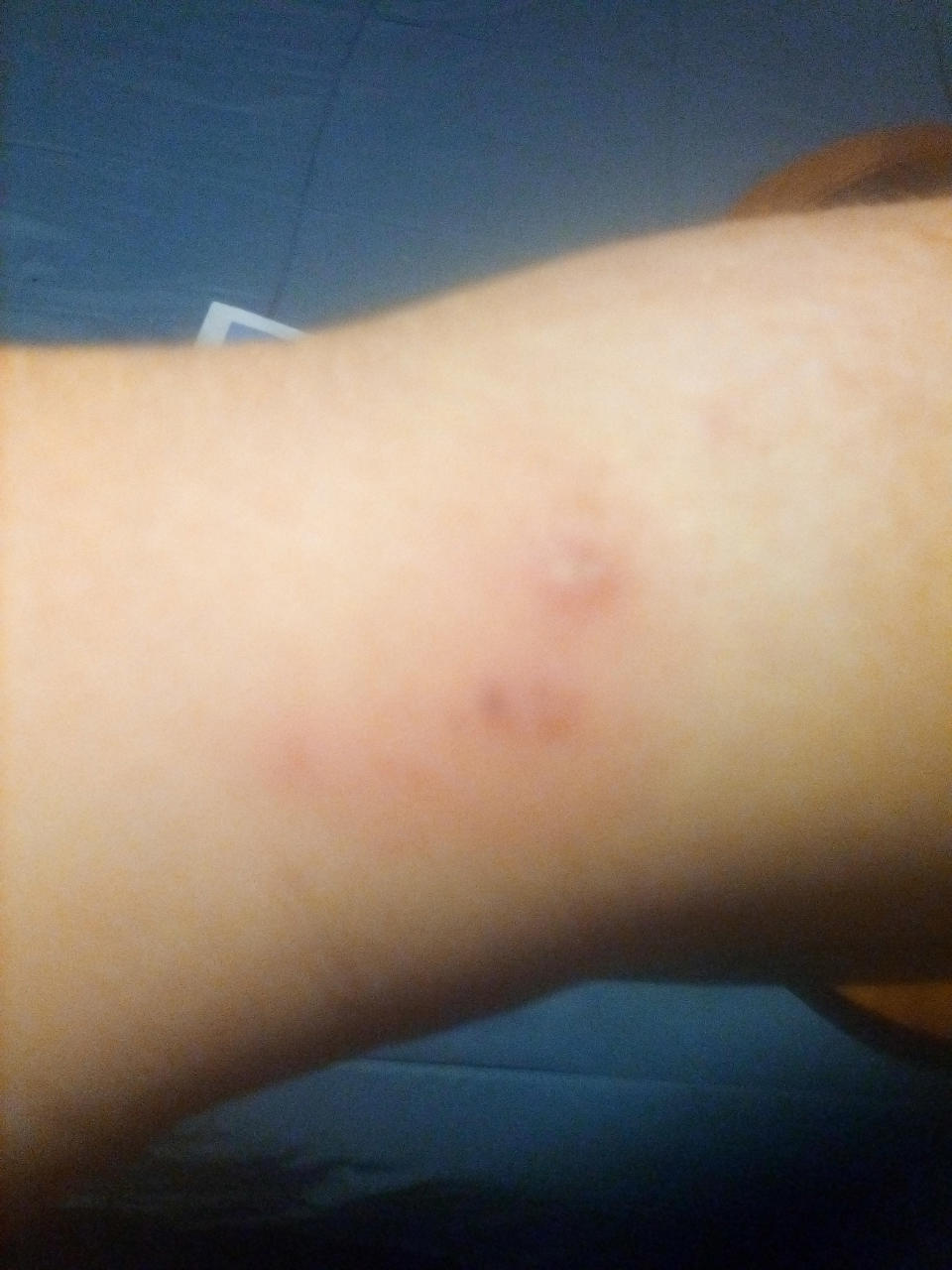 Pictured are two abrasions on Nikita Aldridge's arm caused by a yellow-faced whipsnake bite. 