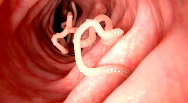 The woman contracted hookworm, an intestinal parasite. Photo: Getty