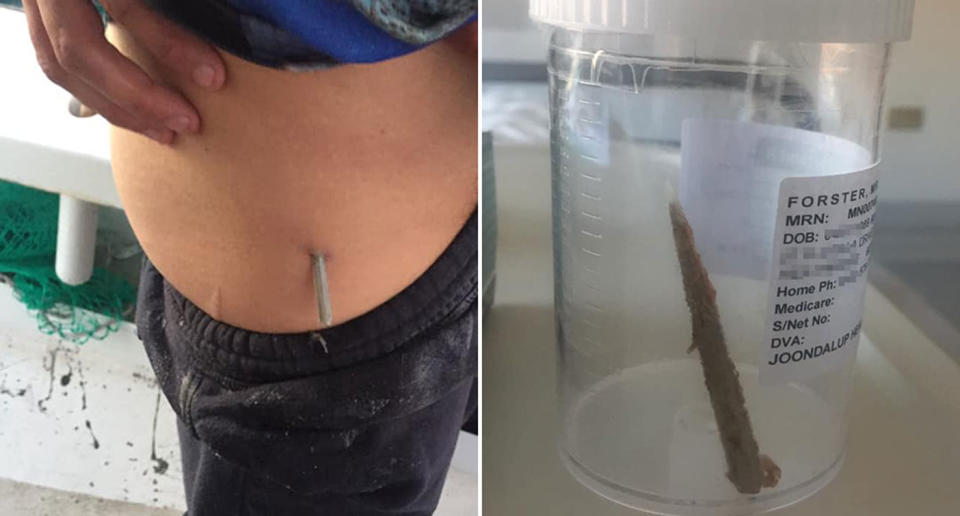 A picture of a stingray barb penetrating a hip and the barb removed in a hospital container. A Perth fisherman shared the pics warning people to be careful when unhooking stingrays.