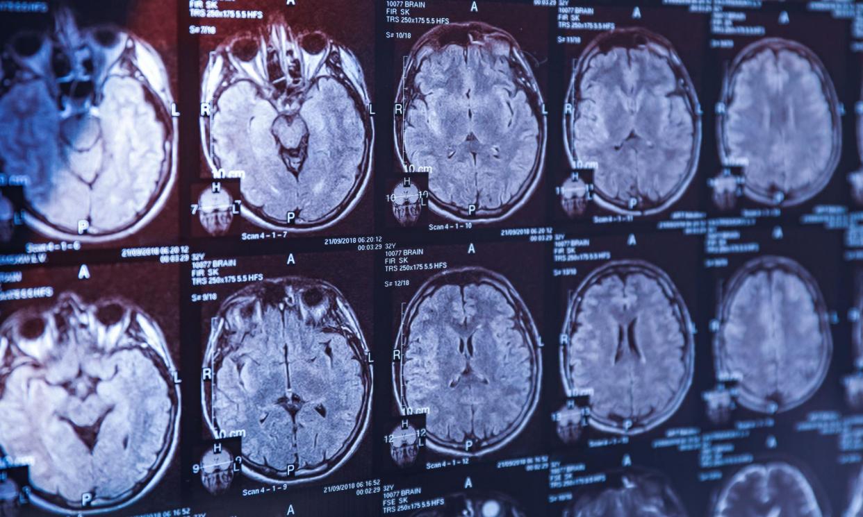 <span>MRI head scans: lecanemab removes sticky clumps of protein amyloid beta from the brain, believed to be a hallmark of Alzheimer’s.</span><span>Photograph: Pixel-shot/Alamy</span>